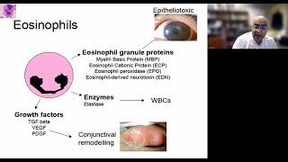 Lecture Vernal Keratoconjunctivitis [upl. by Rugen]