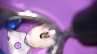 Ultraschall in der Endodontie [upl. by Htezil655]