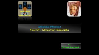 Ultrasound Case 68  Mesenteric Panniculitis [upl. by Haidebez]