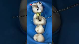 ¡🔥EXTIRPACIÓN del nervio en una muela con limas de ENDODONCIA🔥 [upl. by Liarret]