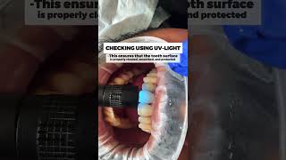 Removing Invisalign Attachments shorts dentistry invisalign [upl. by Raimes]