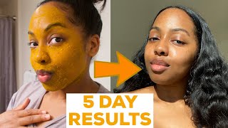 I DID A 5 DAY TURMERIC FACE MASK amp This Happened  MISS C Beauty [upl. by Lachance]