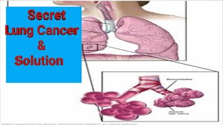 Lung Cancer Secrets amp SolutionsWhat You Need to Know [upl. by Iatnohs]