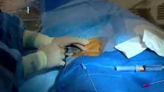 Live Webcast Cardiac Catheterization Angioplasty amp Stent [upl. by Haimirej]