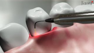 TwinLight® Periodontal Treatment [upl. by Naanac885]