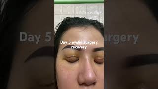 Day 5 eyelid surgery [upl. by Brian]