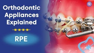 Orthodontic Appliances Explained  RPE [upl. by Meagher875]