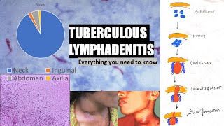 Tuberculous lymphadenitis  stages of cervical lymphadenitis  cold abscess  collar stud abscess [upl. by Anyat94]