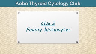 Diagnostic clues and pitfalls of thyroid FNA Clue 2 Foamy histiocytes [upl. by Ericha799]