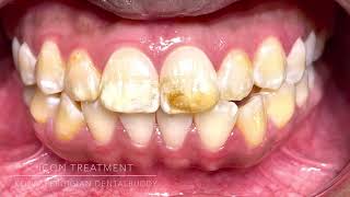 Icon treatment Fluorosis [upl. by Muslim941]