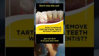 Removing Plaque From Teeth  How To Get Tartar off Teeth at Home tarta teeth dental [upl. by Draude]