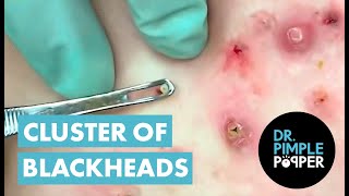 50 Minutes of Blackheads Clusters of Blackheads with Dr Pimple Popper [upl. by Sherrill]