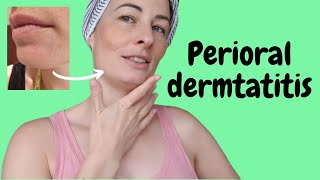 Perioral Dermatitis treatment naturally  Amperna  video 2 [upl. by Jacobs]