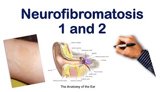 Neurofibromatosis NF 1 2 Mnemonic  USMLE STEP COMLEX NCLEX [upl. by Sillsby]