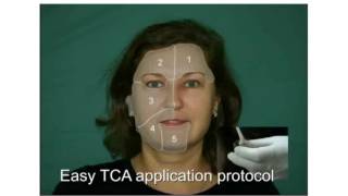 Skin Tech guide for patients Easy TCA treatment [upl. by Riamo]