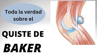 QUISTE DE BAKER DE LA RODILLA  LO QUE HE APRENDIDO EN 20 AÑOS DE EXPERIENCIA [upl. by Park298]