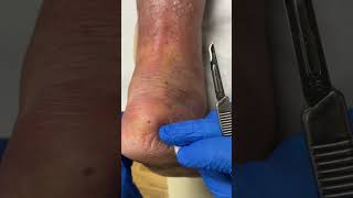 Watch an Aussie podiatrist tackle some serious heel corns amp callus HardSkin PodiatryMagic [upl. by Wilsey]