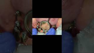 Proper Alveoloplasty  No gum shrinkage even after 2 years  Mandible full implants [upl. by Lanny]