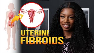 Uterine Fibroids Complications  MarieCatherine Kodjo [upl. by Obie8]