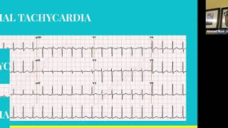 ARRHYTHMIAS [upl. by Atteuqal992]