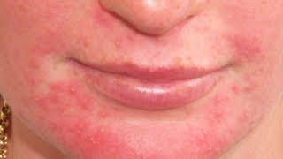 Home Remedies for Perioral Dermatitis [upl. by Leaffar981]