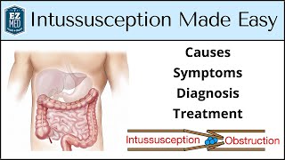 Intussusception Causes Symptoms Diagnosis Treatment Nursing USMLE [upl. by Megan947]