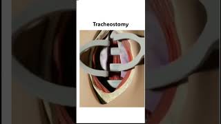 Tracheostomy shorts mbbs femalereproductivesystem pregnancy [upl. by Ardnaxila]