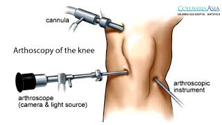 How long does it take to recover from Arthroscopic Knee Surgery [upl. by Omocaig391]