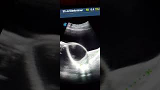 Ovarian Cyst Ultrasound [upl. by Oznole]