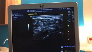 Ultrasound Guided Barbotage Procedure for Calcific Tendonitis in Shoulder [upl. by Truc147]