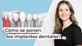 ¿Cómo se ponen los implantes dentales paso a paso  Clínica dental en Alcobendas Avodent [upl. by Nylaras]