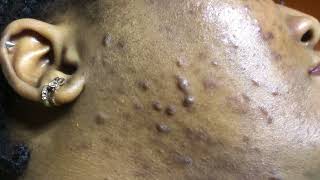 keloid amp hypertrophic acne scars [upl. by Angelica]