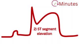 Understanding Myocardial Infarction STEMI ECG Evolution Explained [upl. by Irpac]