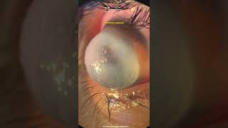 The Beautiful Cases Keratoconus Keratoglobus Corneal Hydrops [upl. by Esom]