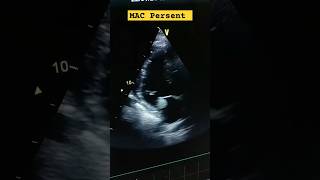 Global LV hypokinesia Severe LV Dysfunction Moderate Aortic stenosis MAC hferf heartfailure [upl. by Allimrac]