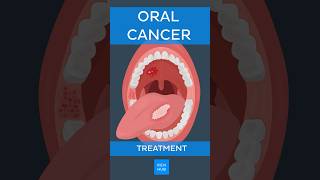 Oral cancer Treatment  Kenhub oralcancer [upl. by Drannel653]