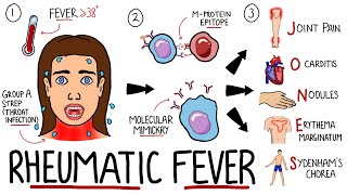 Rheumatic Fever Made Easy Including Jones Criteria and Mnemonic [upl. by Caralie]