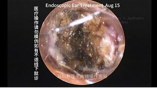 External auditory canal cholesteatoma misdiagnosed as cerumen embolism [upl. by Idyh]