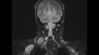 Neurofibromatosis [upl. by Legra]