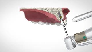 Abutment Screw Retrieval Instrument [upl. by Kalvn]