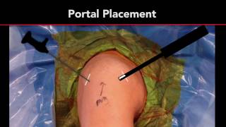 Calcific Tendonitis Treatment  Arthroscopic Rotator Cuff Repair  Shoulder Surgeon [upl. by Marsiella903]