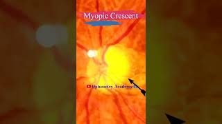 Myopic Crescent  Fundus Photography  Tesselations  Short Video 100 [upl. by Tullusus324]