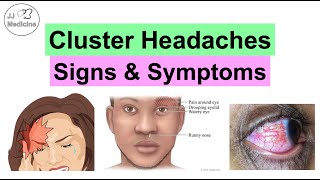 Cluster Headaches Symptoms Associated Issues amp Triggers [upl. by Nahallac]