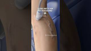 Super glue for your veins 3D Animation [upl. by Tavey]