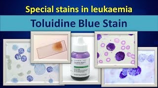 Toluidine blueSpecial stain in leukaemia [upl. by Eniahs]