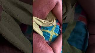 Stretch mark removal in India [upl. by Ranilopa]