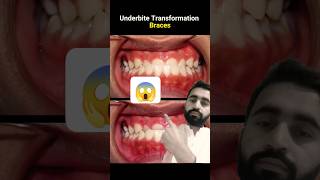 Under bite braces evolution braces orthodontist dentist dentistry [upl. by Brebner]