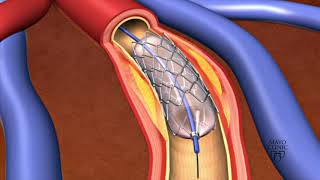 Animation  Coronary stent placement [upl. by Yrailih]