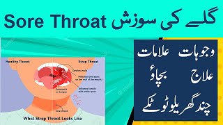 Sore Throat  Causes Symptoms Treatment Prevention and Cautions  Urdu  Hindi  Shahbaz Qamar [upl. by Anahpets]