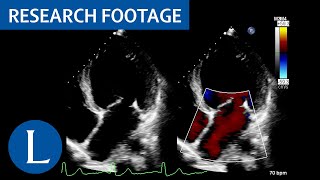 Dilated left ventricle with global hypokinesia LibmanSacks endocarditis 1 of 4 [upl. by High804]